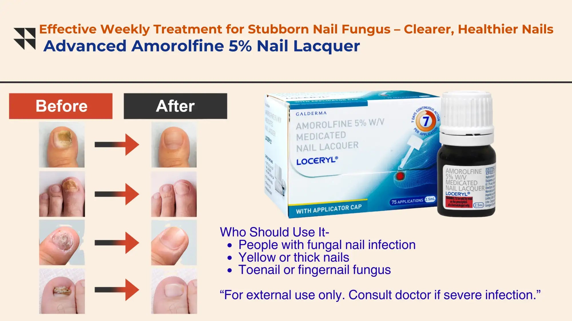 Calderma locryl advanced amorolfine 5% nail lacquer in a dark glass bottle with a white cap and blue packaging.