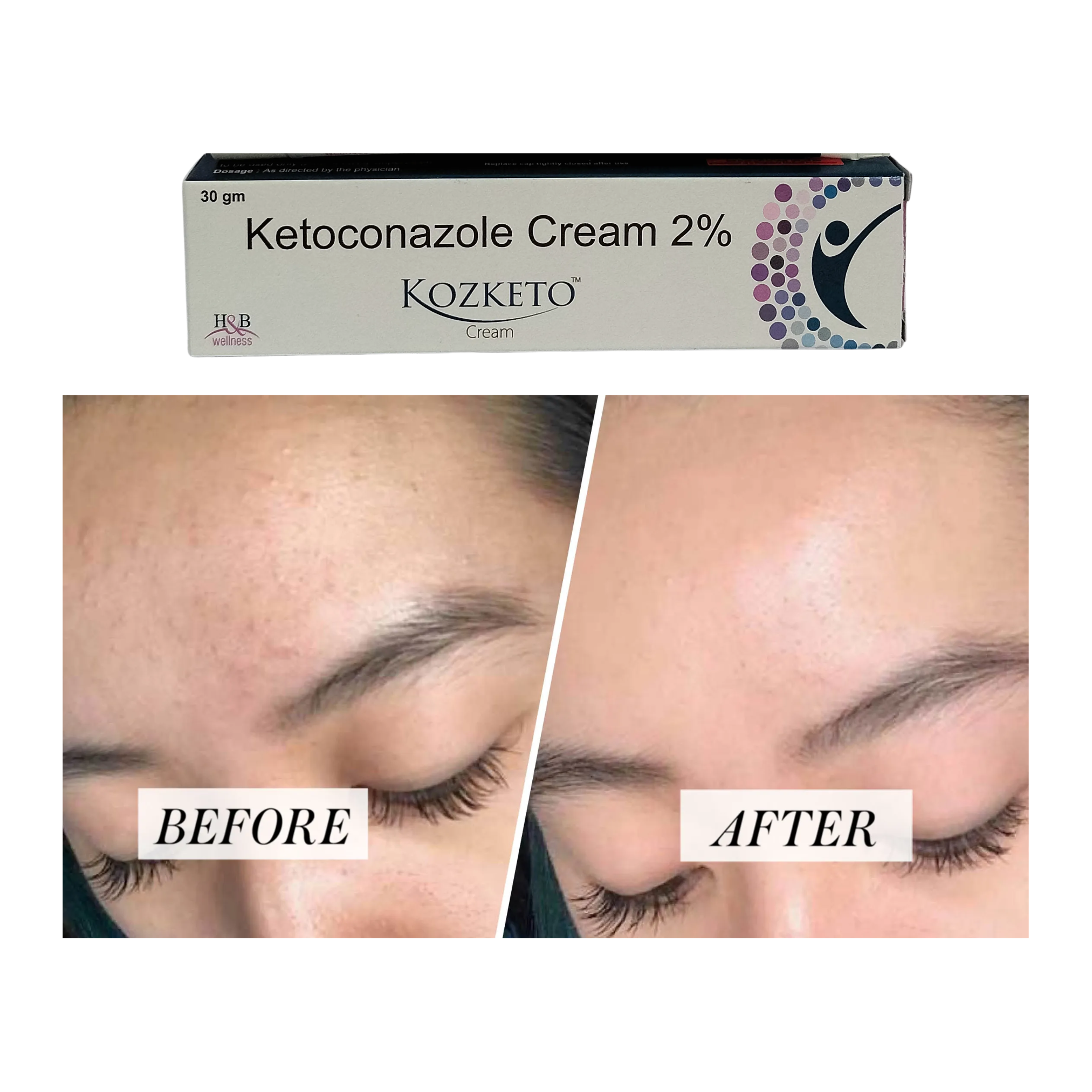 Kozketo cream 30gm pack of 2 with ketoconazole 2 percent for external skin use