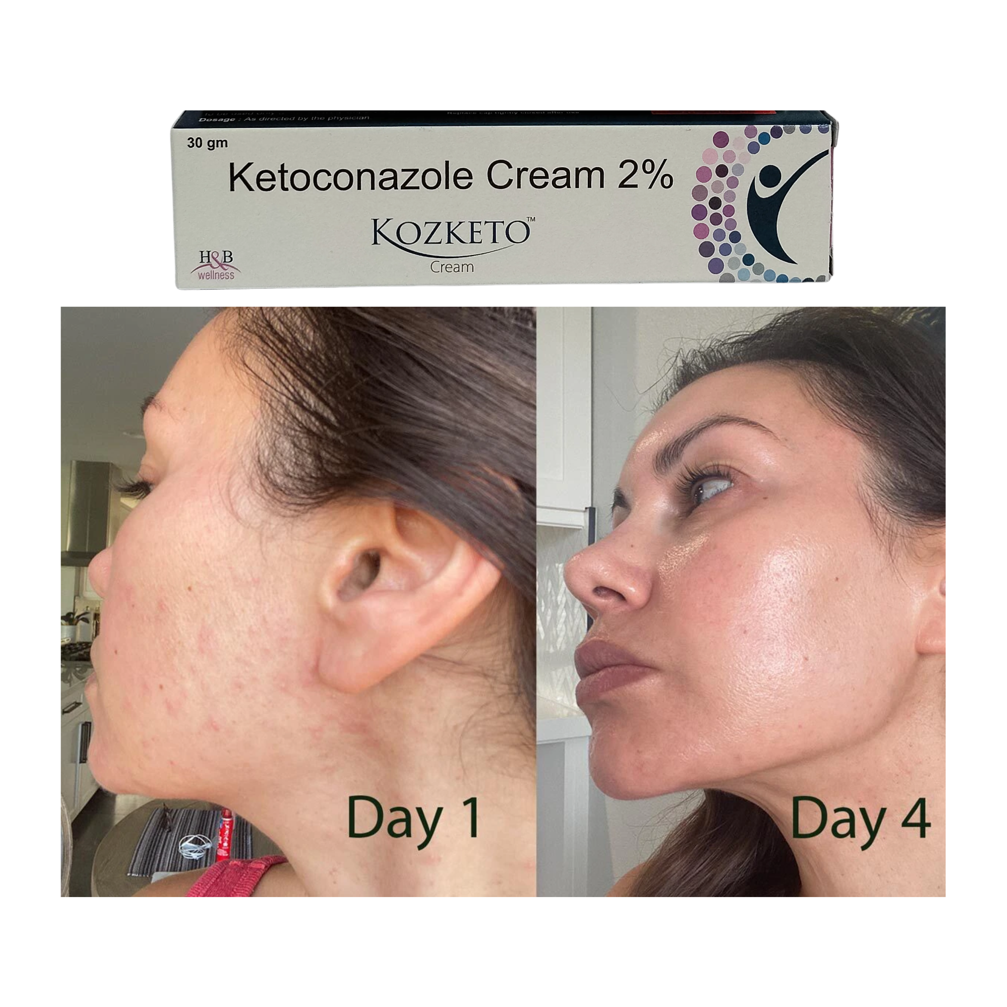 Kozketo cream 30gm pack of 2 with ketoconazole 2 percent for external skin use