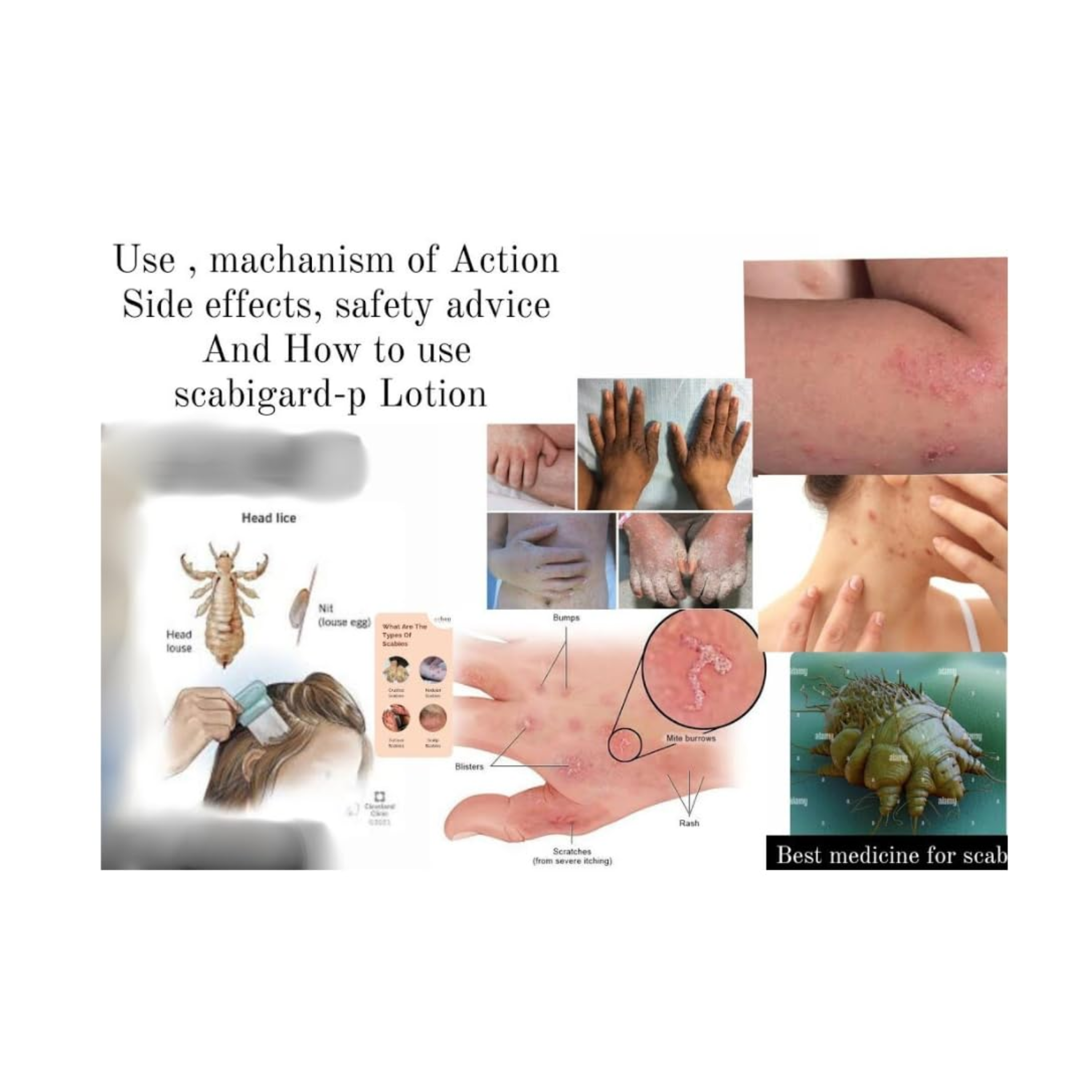 Scabigard-P Permethrin 5 percent cream 50ml pack of 4 for external skin use