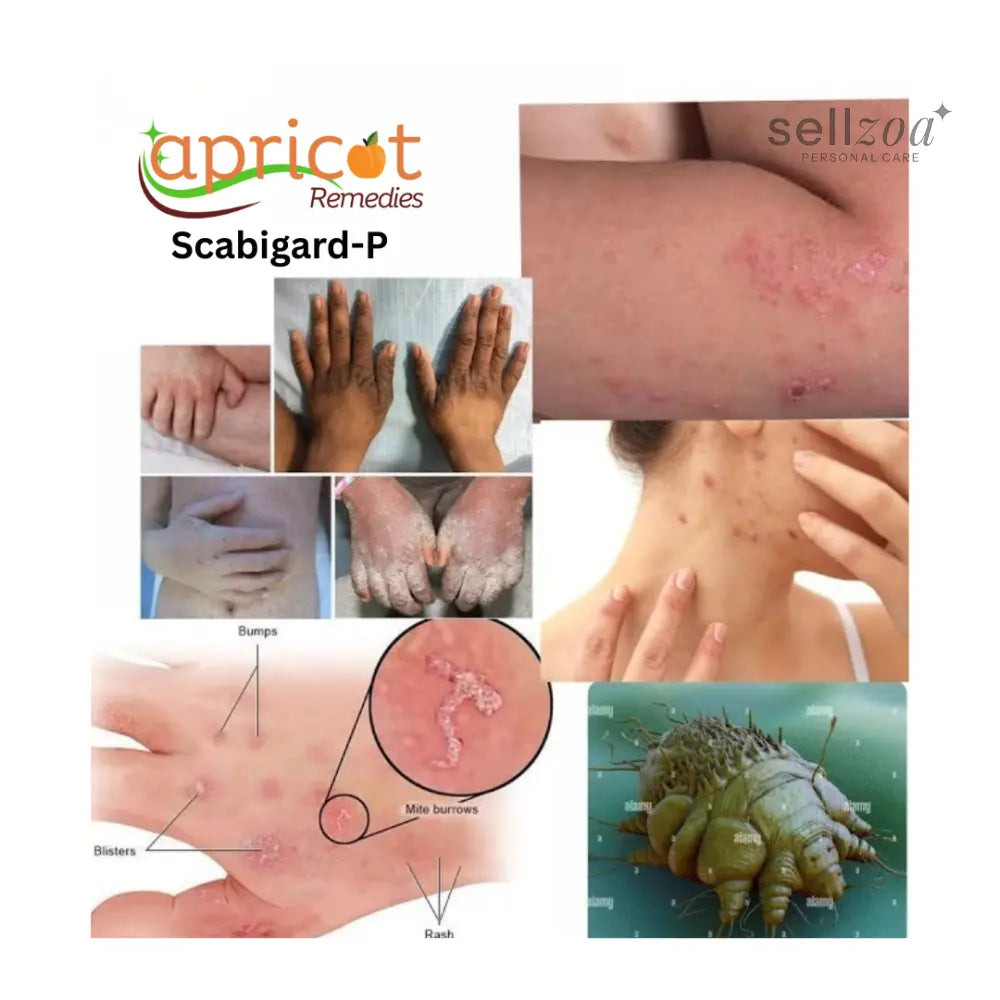 Scabstar Permethrin 5 percent cream 50ml pack of 4 for external skin use